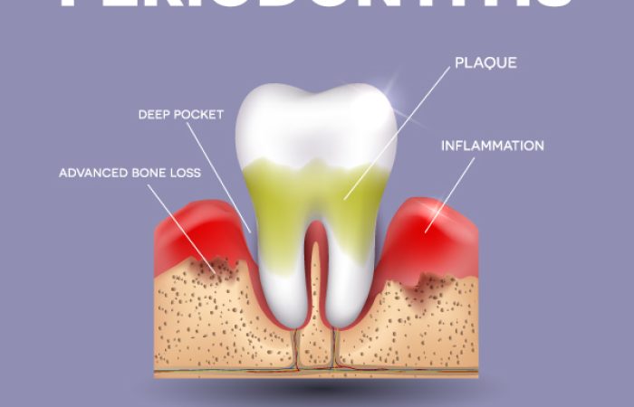periodontitis-bone-loss